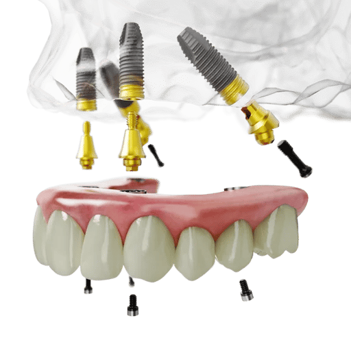All-on-4 TiUltra_upper jaw NobelParallel-1
