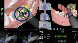 BXNAVsw1_Drill-Surgical-NavigationCROP