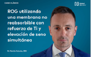 Dr. Colombo - ROG utilizando una membrana no reabsorbiblr con refuerzo de Ti y elevación de seno simultánea 